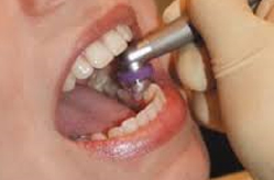 Bezbolestné odstranění zubního kamene